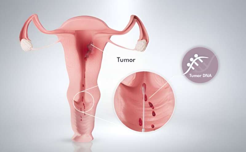 Simple womb cancer test could reduce need for invasive diagnostic procedures