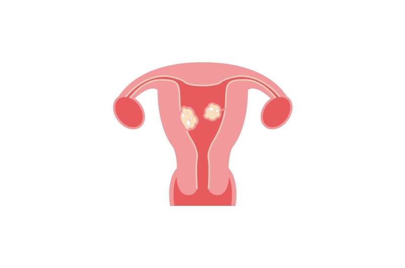 Nonsurgical treatment for uterine fibroids