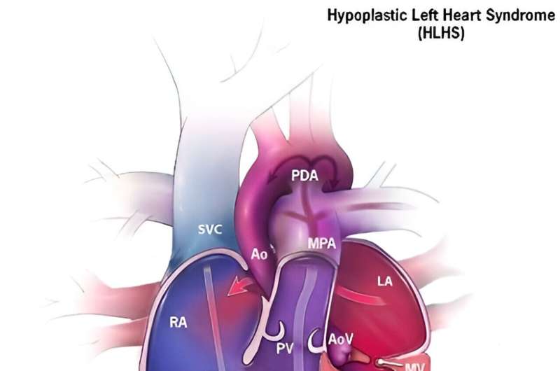 Abortion bans increase need for congenital heart defect care, Stanford Medicine study finds