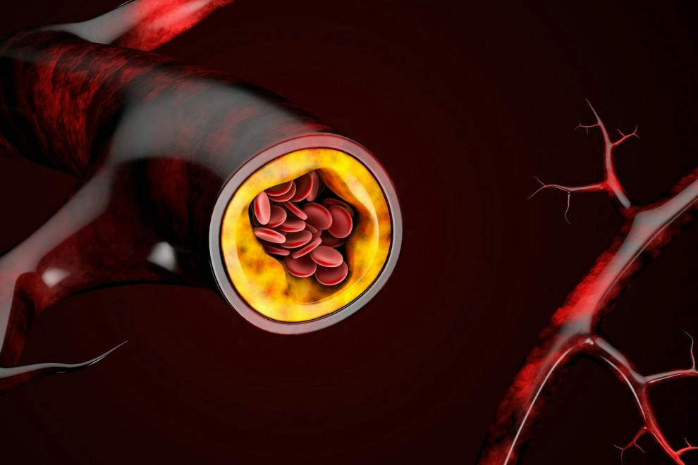 Insuficiencia arterial: causas, síntomas y tratamiento