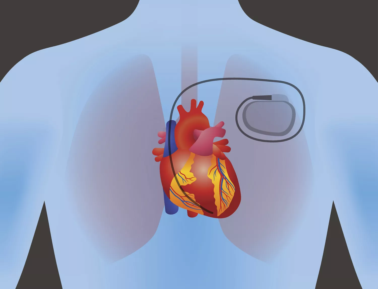 When a Pacemaker Is Needed for a Heart Block