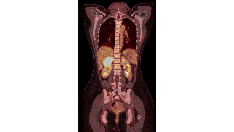 Adrenocortical carcinoma: No mitotane for low risk of recurrence