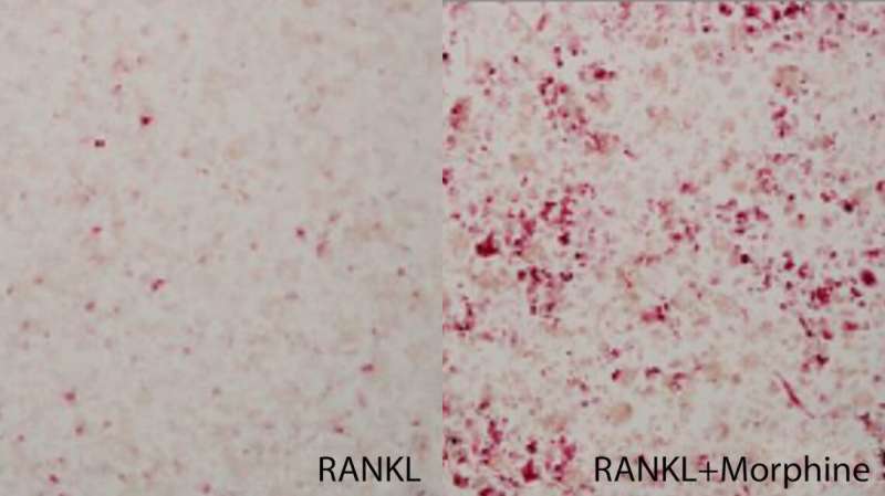 Study shows how morphine may contribute to bone loss and cancer-induced bone pain