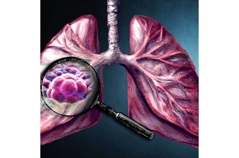 Tumor matrix profiling gives clues to progression of some lung cancers 