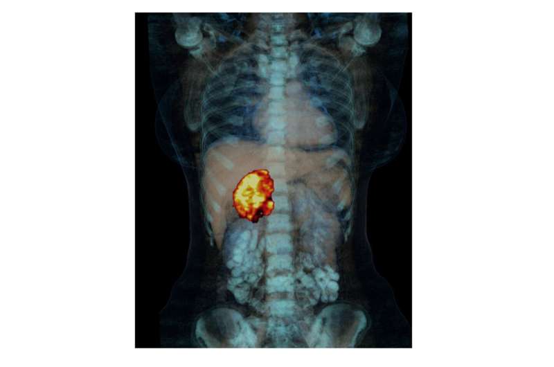 Adrenocortical carcinoma: No mitotane for low risk of recurrence