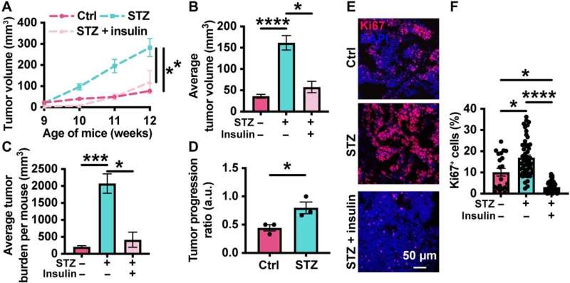 Study finds that diabetes may hasten breast cancer tumor growth and stiffness