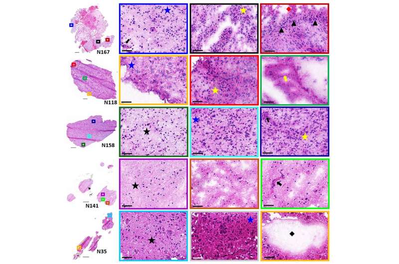 Seeking microscopic clues to beating deadly brain tumors