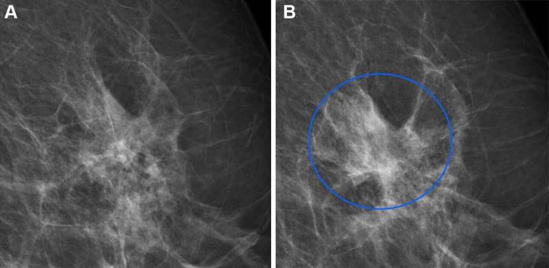 Combining AI models improves breast cancer risk assessment