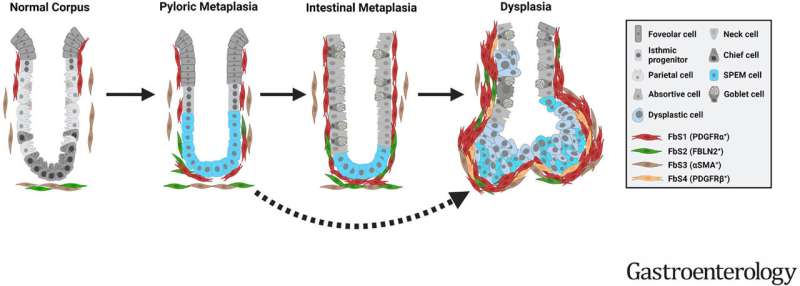 Study reveals new clue to gastric cancer