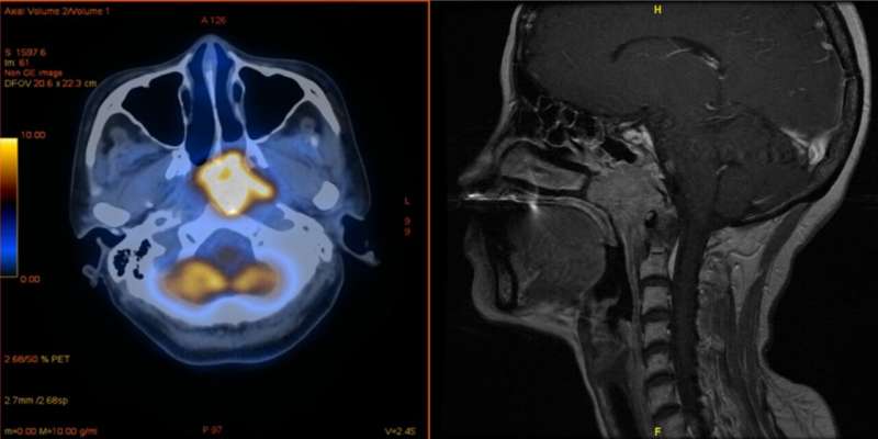 COVID vaccination improves effectiveness of cancer treatment