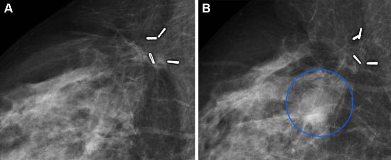 Combining AI models improves breast cancer risk assessment