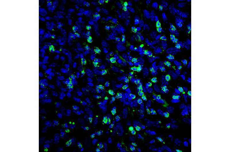 Heart medication improves the efficacy of current treatments for melanoma in mouse models