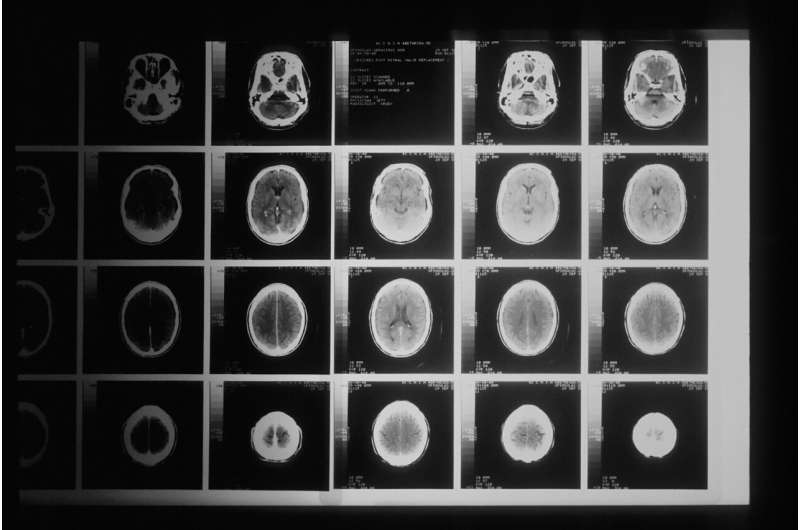 Yearly scanning not required for common brain tumor detected in 1 in 10 people, study shows