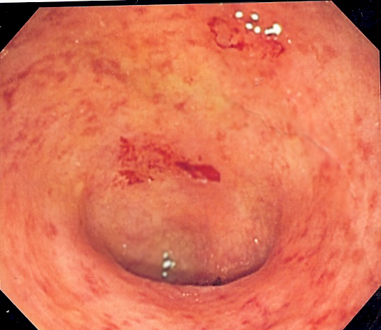 ulcerative colitis