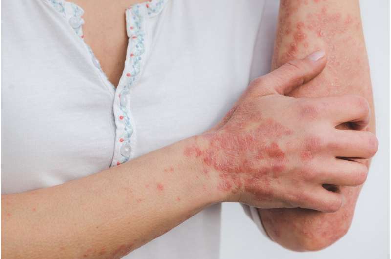 Few studies include photos of patients with psoriasis, finds review