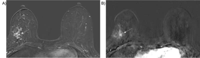 Predicting DCIS upgrade to invasive cancer at breast surgery with ultrafast imaging