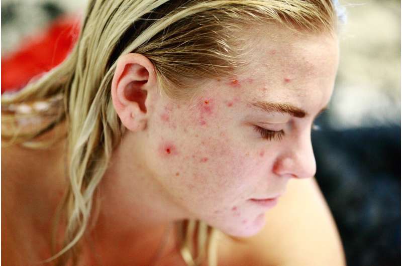 Uncovering the emotional scars: Study reveals significant stigma associated with female adult acne