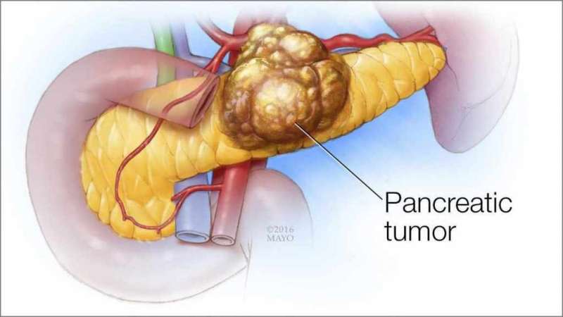 Researchers ID potential gene marker for treating pancreatic cancer