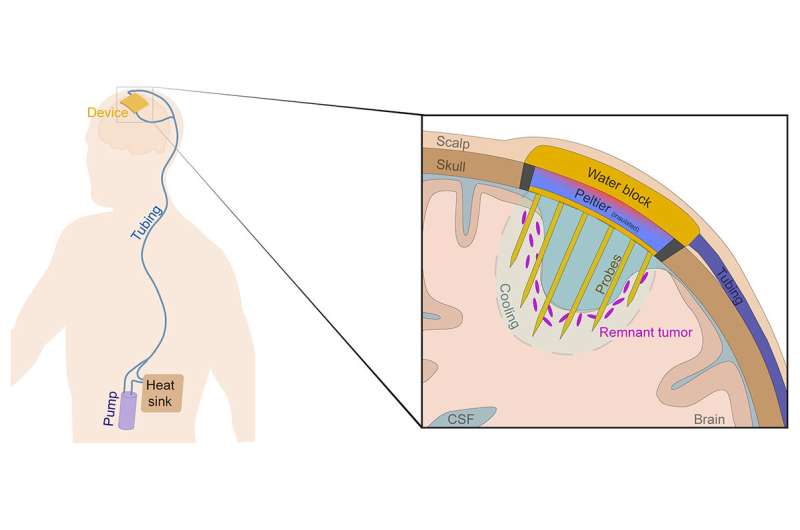 Cooling glioblastoma to room temperature extends survival in preclinical study