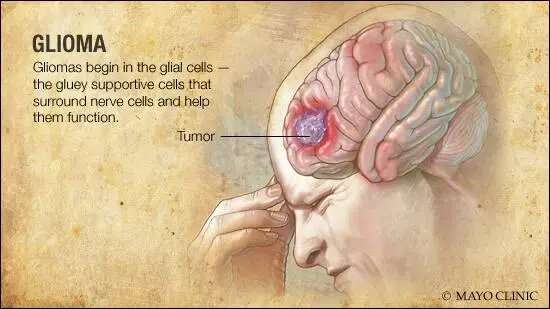 Research provides critical information about size and growth speed of gliomas