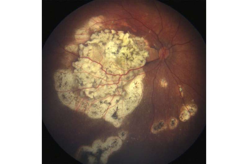 Researchers discover new molecular driver of retinoblastoma