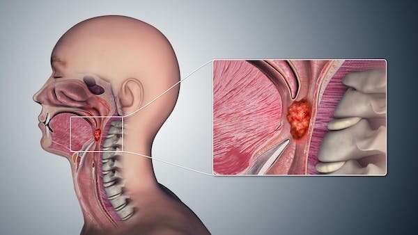 Oral sex is now the leading risk factor for throat cancer