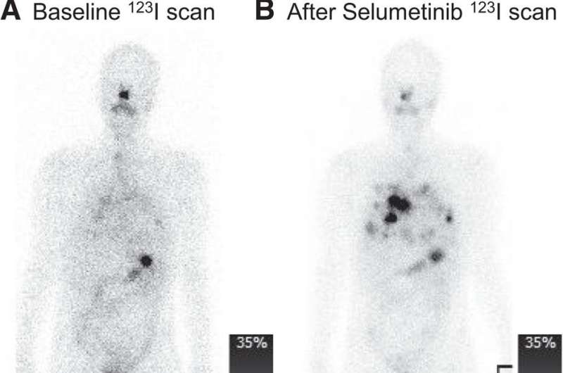 Pretherapy imaging and dosimetry offer personalized treatment planning for thyroid cancer patients