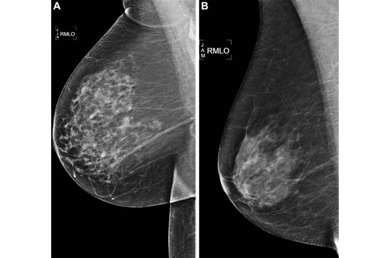 AI outperformed standard risk model for predicting breast cancer