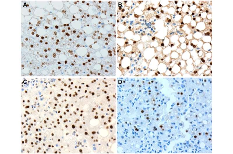 Expression of p-STAT3 and c-Myc correlates with P2-HNF4α expression in nonalcoholic fatty liver disease (NAFLD)