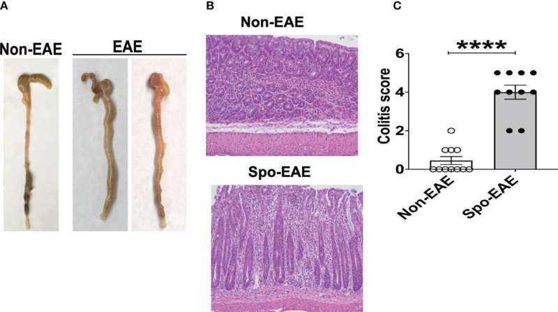 Poor gut health may drive multiple sclerosis—better diet may ease it