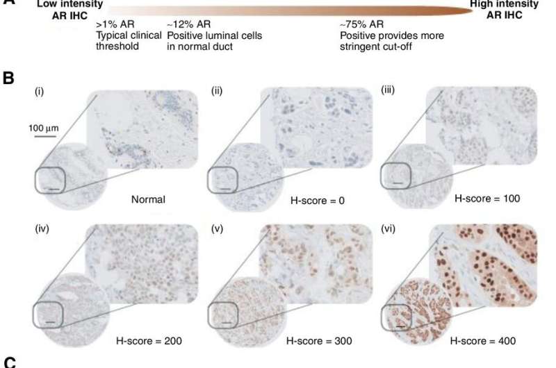 Hormone profiling could be used to improve survival rates for breast cancer