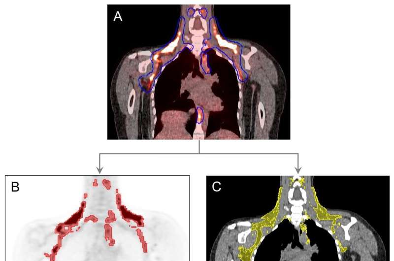 Active brown adipose tissue protects against “pre-prediabetes”