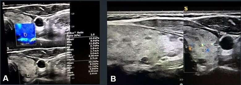 Vascularity, elastography in suspicious TIRADS scores differentiate malignant thyroid nodules