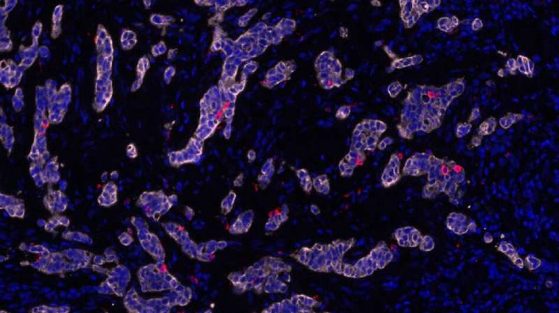 Study opens route to overcoming drug resistance in stomach cancer