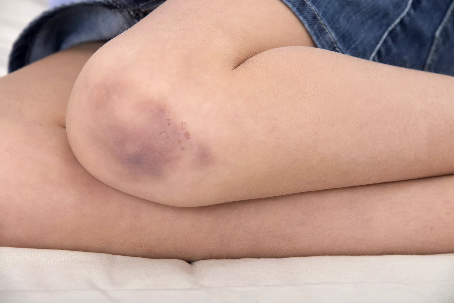 Signs and Symptoms of Abnormal Bruising in Children