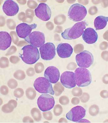 Acute lymphoblastic leukemia