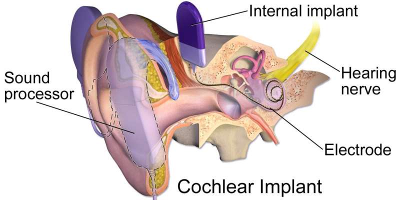 Cochlear implant in deaf children with autism can improve language skills and social engagement 