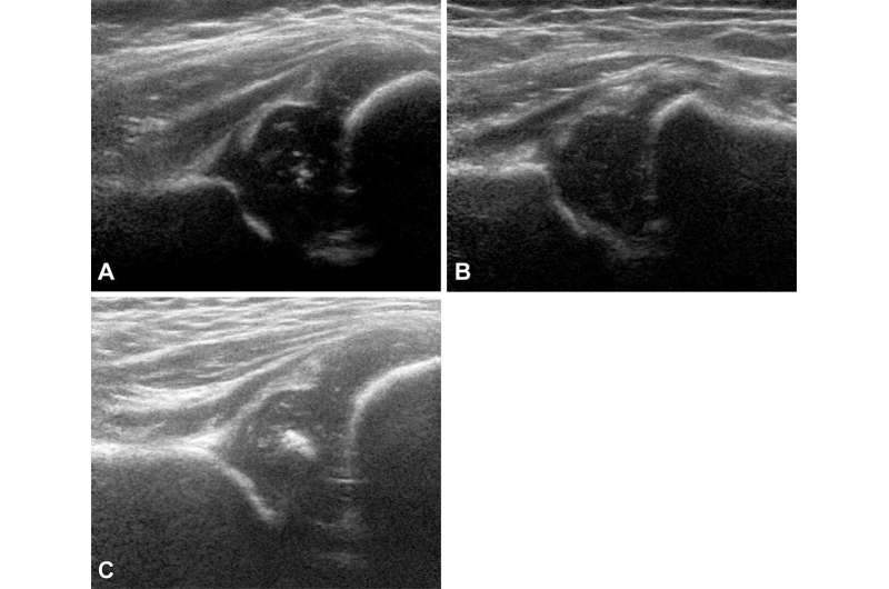 Ultrasound technique predicts hip dysplasia in infants