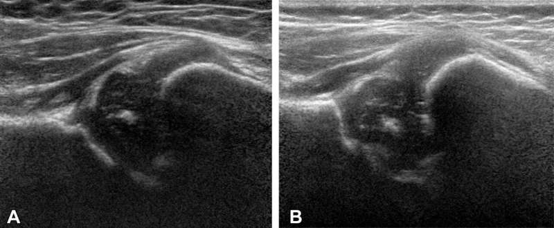 Ultrasound technique predicts hip dysplasia in infants