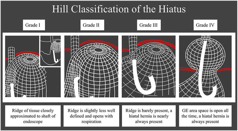 White paper recommends expanding endoscopic classification of esophagogastric junction integrity beyond hill grade