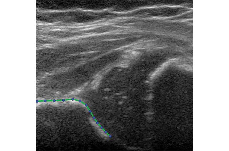 Ultrasound technique predicts hip dysplasia in infants