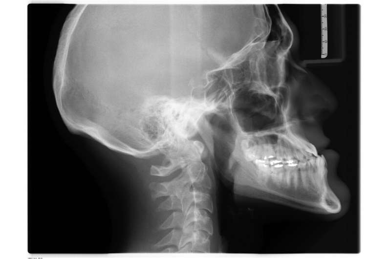 International comprehensive consensus issued on management of achondroplasia