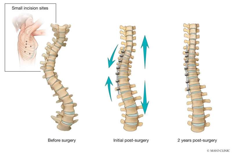 Vertebral body tethering: Another option for treating scoliosis in children 