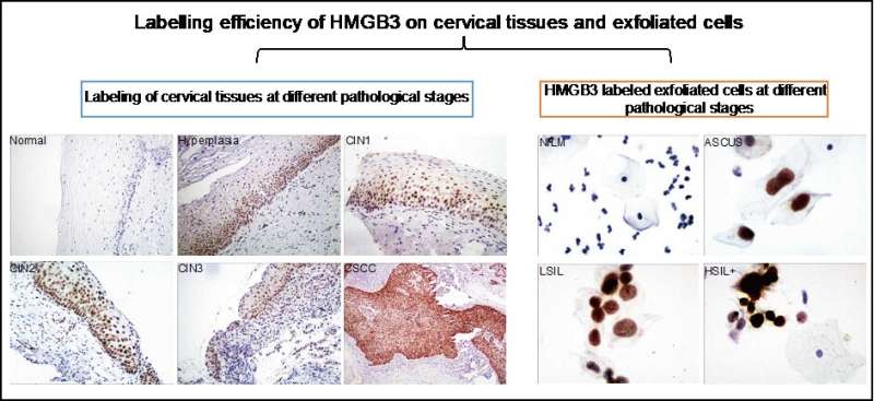 New technology developed for early detection of cervical precancerous pesions