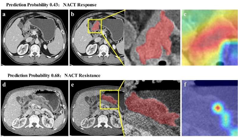 Novel method for predicting efficacy of neoadjuvant chemotherapy for advanced gastric cancer