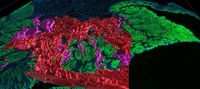 Researchers are building detailed maps of colorectal cancer to better understand the dynamics of the disease 