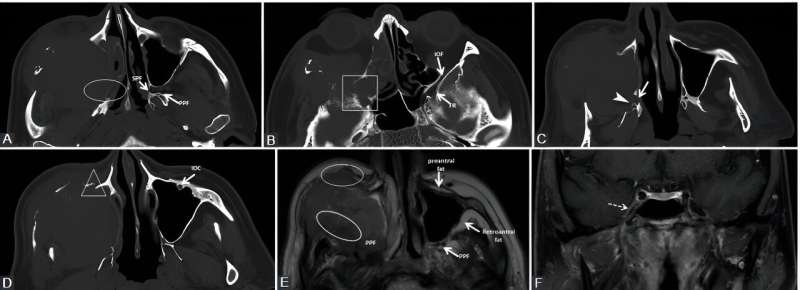 The Hidden Challenge: Imaging Perineural Invasion in Head and Neck Tumors