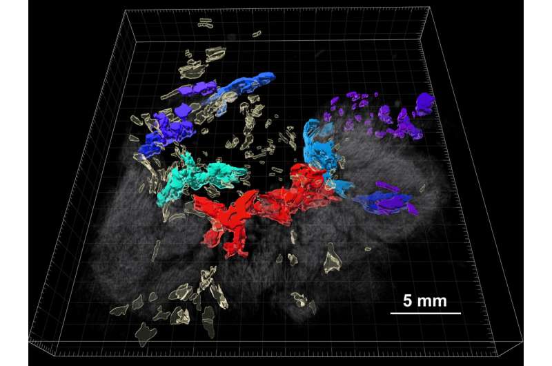 An unprecedented look at colorectal cancer