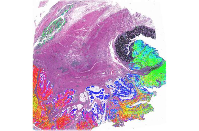 An unprecedented look at colorectal cancer