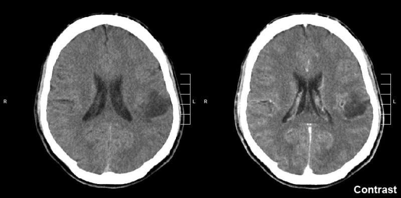 Spinal fluid sampling used to track treatment response in pediatric glioma 